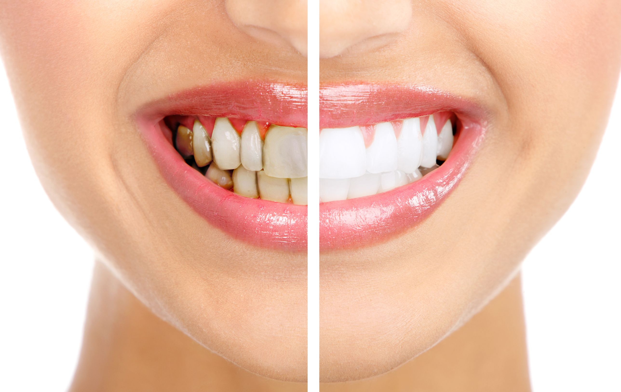 Reasons to Visit an Office Offering Dental Care Services Beaver Dam, WI for the Best Teeth Whitening Treatments